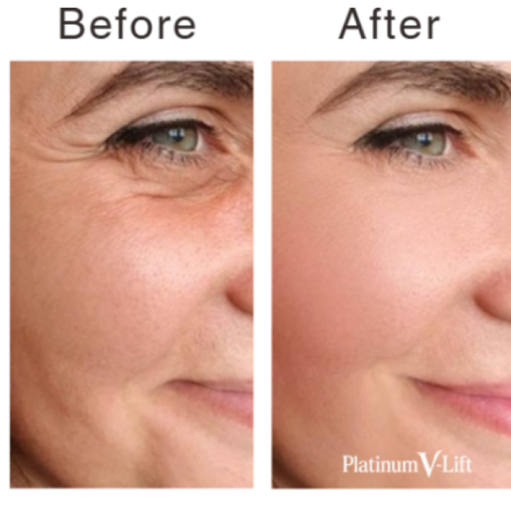 Bipolar RF by ELURENA vs. Thermage: Understanding Radiofrequency Skin Tightening