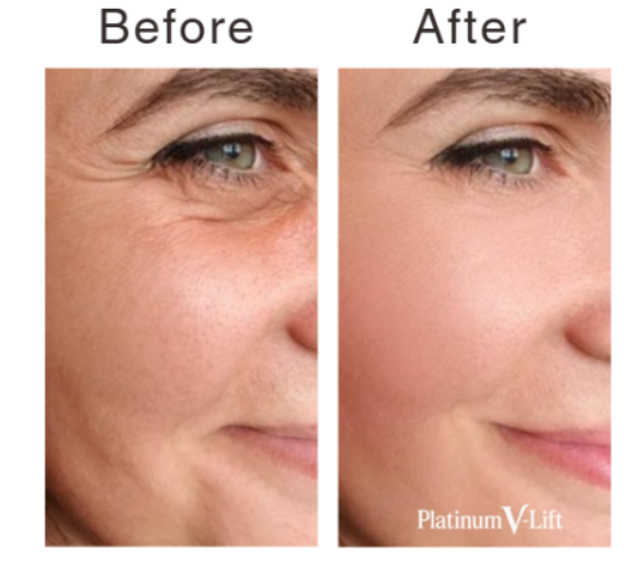 Bipolar RF by ELURENA vs. Thermage: Understanding Radiofrequency Skin Tightening
