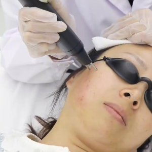 Nitrogen Plasma Skin Regeneration – Face & Neck
