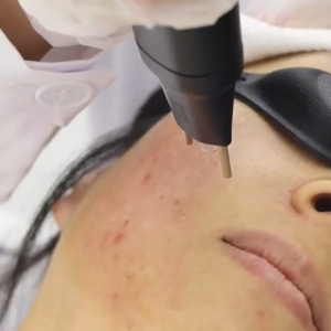 Nitrogen Plasma Skin Rejuvenation - Full Face
